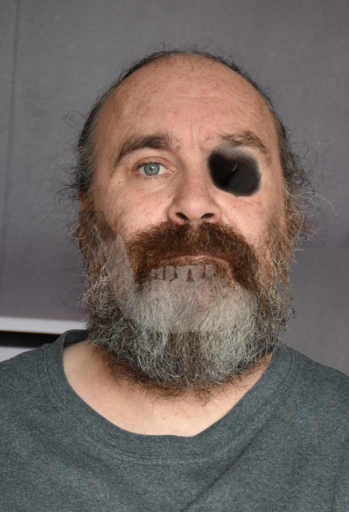 Self portrait, I look forwards into the camera. My left eye socket is grey and empty signifying the loss of sight I feel and the uselessness of the eye.
Shining through the jawline is the outline of a skeletal jaw, a representation of the figure of death, the grim reaper.